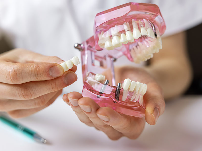 Epident | Dental Sealants, Snoring Appliances and Root Canals